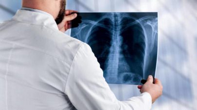 الفحص بالأشعة المقطعية المبكرة يخفض وفيات سرطان الرئة