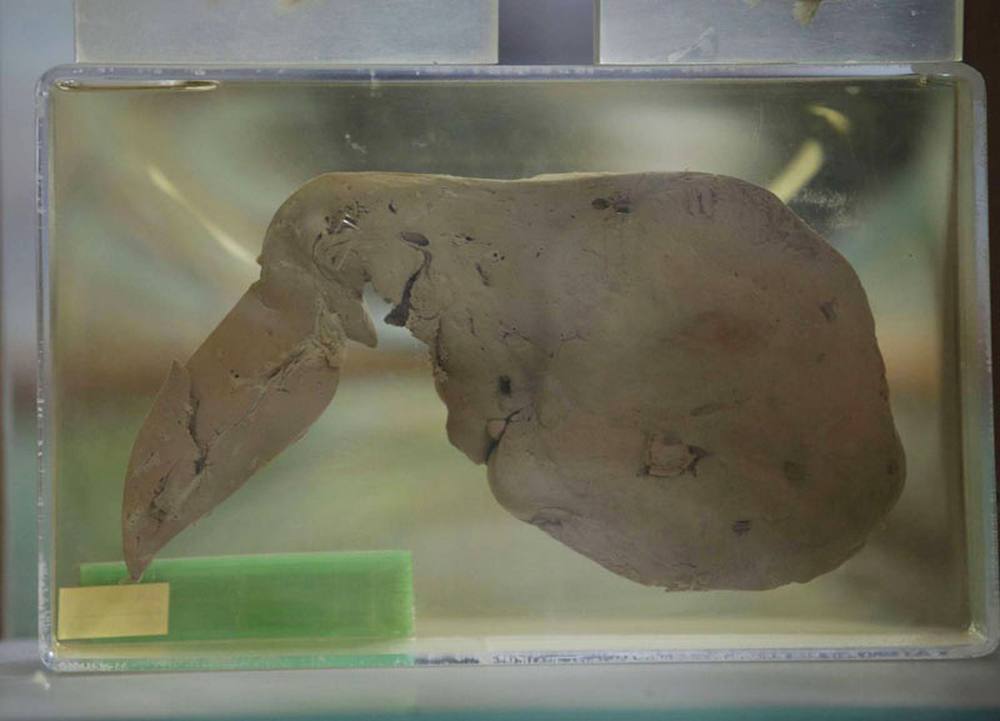 اصفرار بياض العين ينذر بمشاكل في الكبد